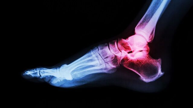 articulațiile rănesc reumatismul artroza deformantă a articulației șoldului în 2 grade
